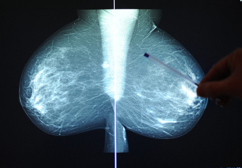 Basler Studie verspricht bessere Brustkrebsbehandlung