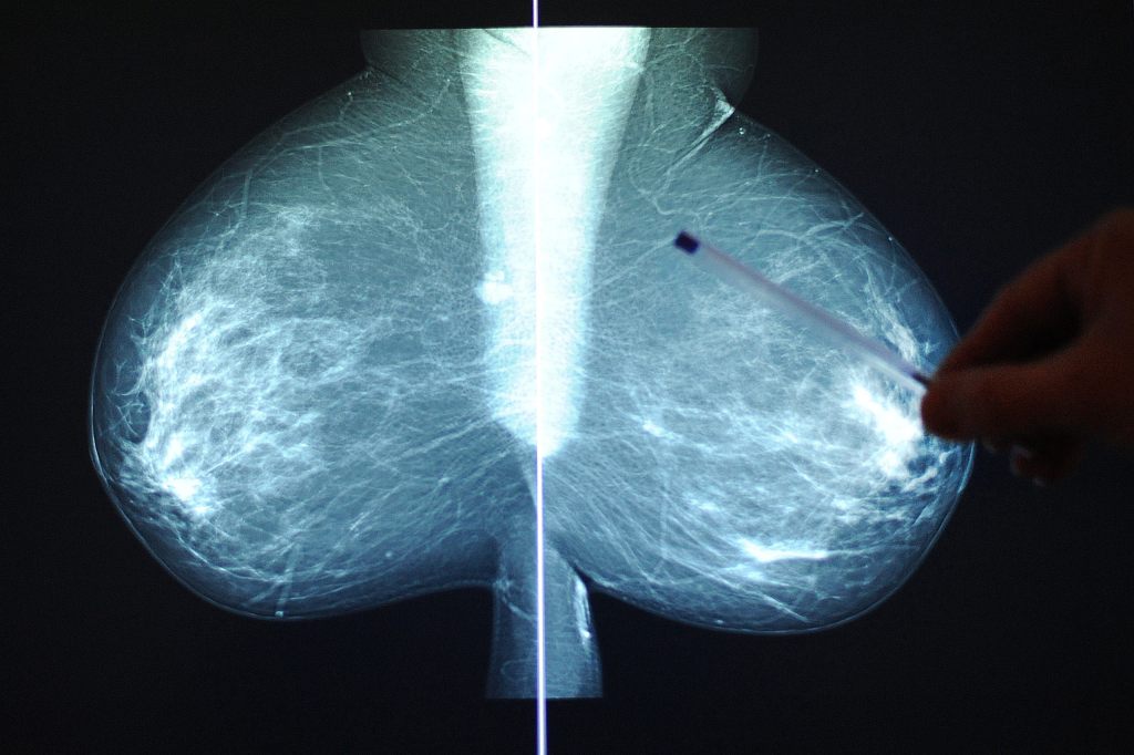 Basler Studie verspricht bessere Brustkrebsbehandlung
