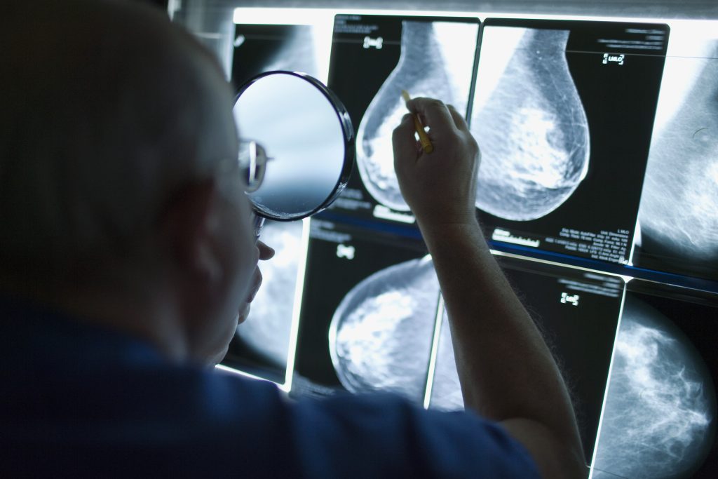 Forscher enthüllen Mechanismus hinter Brustkrebs-Metastasen