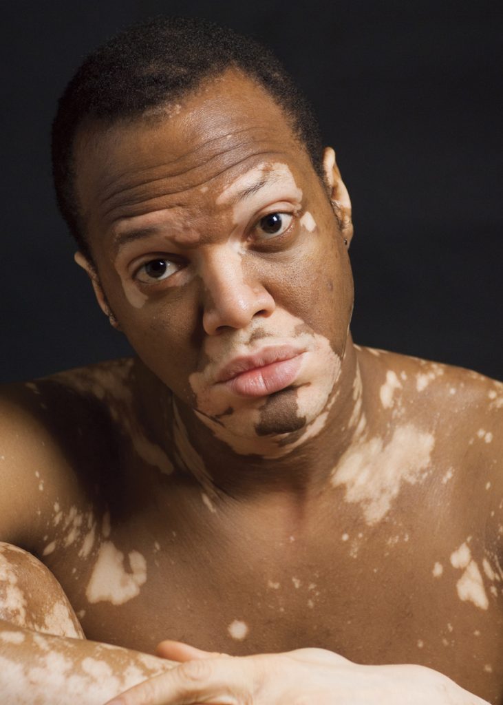 Heute ist Welt-Vitiligo-Tag