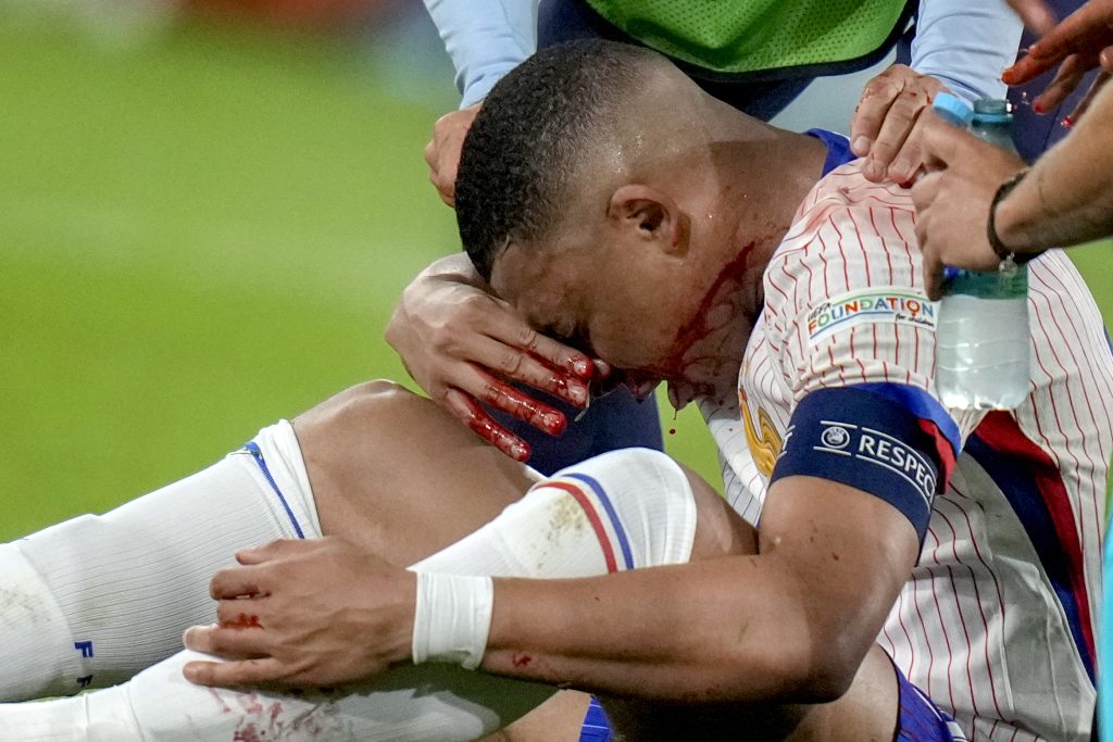 Nasenbeinbruch bei Mbappé bestätigt