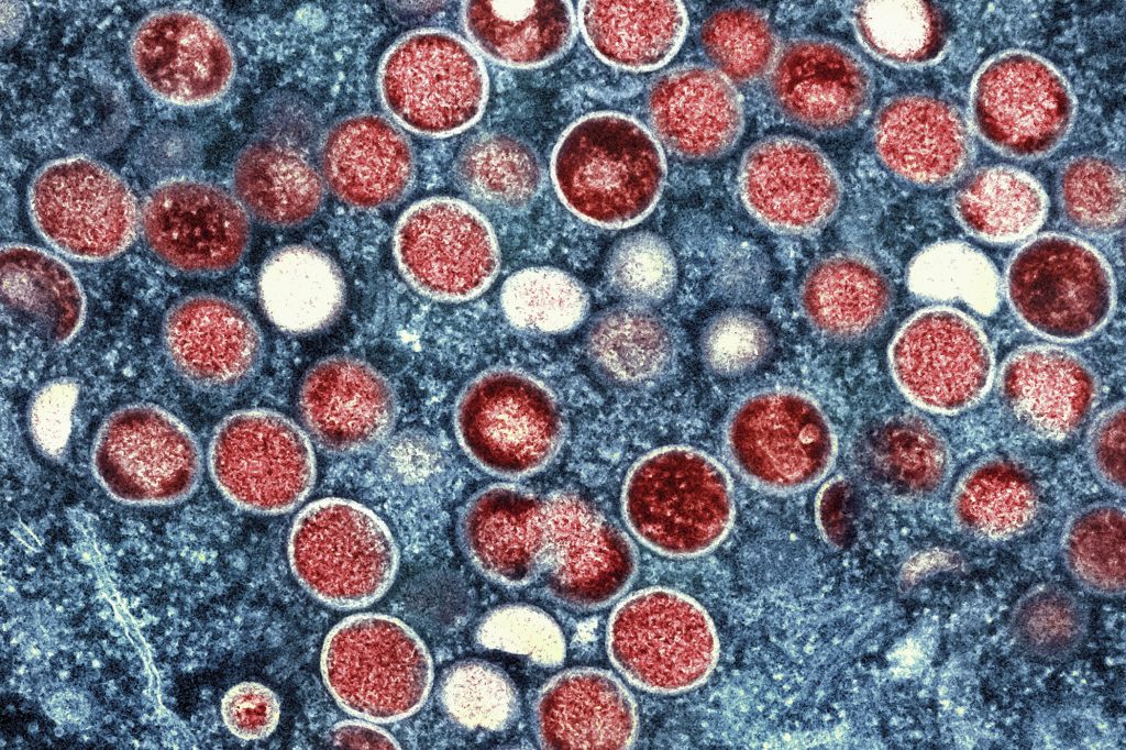 Schweiz sieht geringes Ausbreitungsrisiko der neuen Mpox-Variante