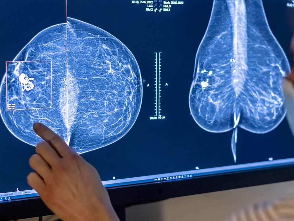 Über 50&#8217;000 Mammografie-Screenings in Basel-Stadt durchgeführt