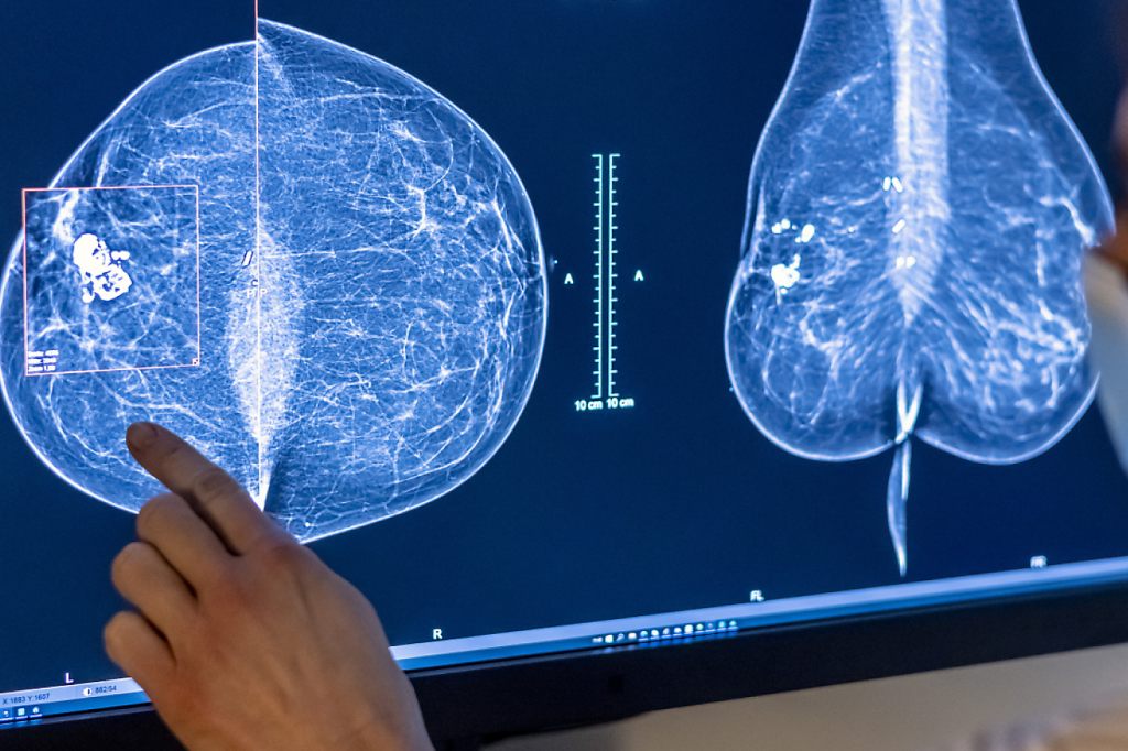 Über 50&#8217;000 Mammografie-Screenings in Basel-Stadt durchgeführt