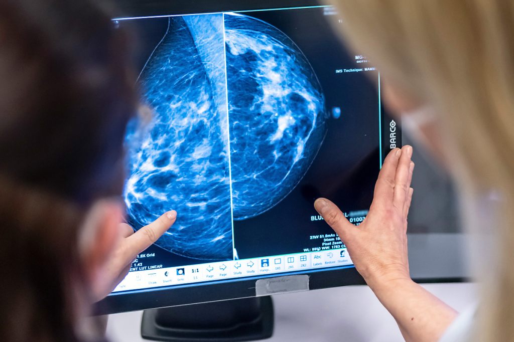 Frauen in Baselland können bald alle zwei Jahre zum Brustkrebs-Check