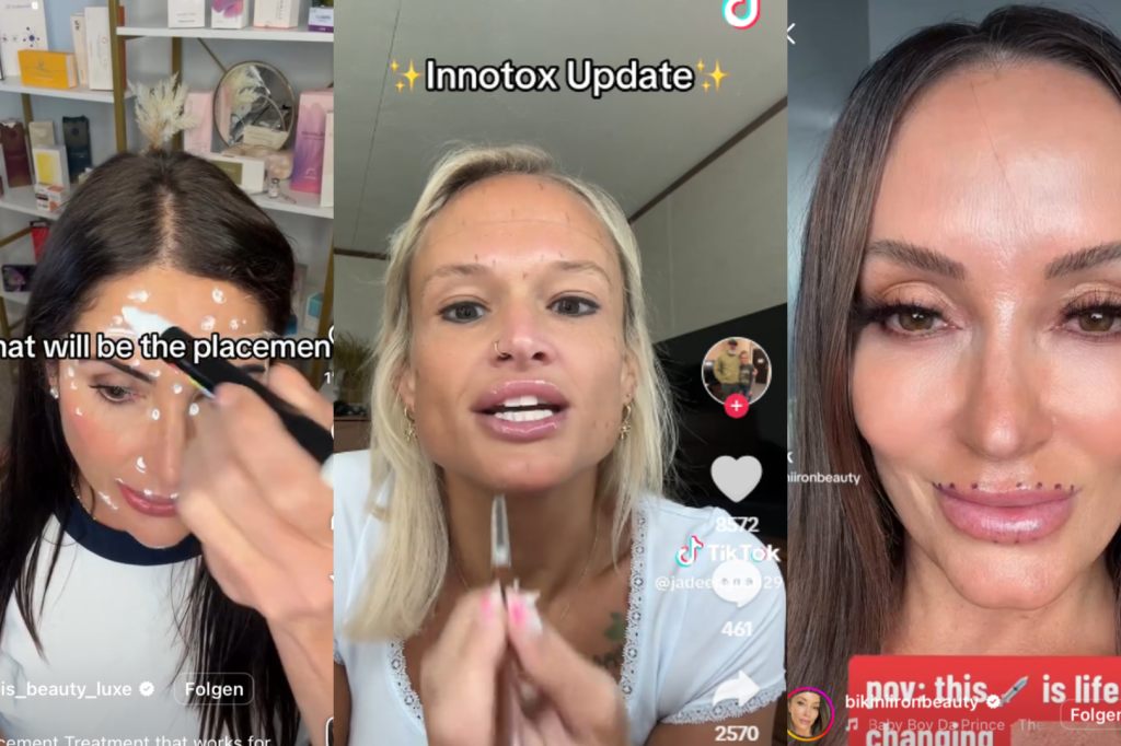 «Do-It-Yourself-Botox»: Der gefährliche Tiktok-Trend sorgt für Alarm