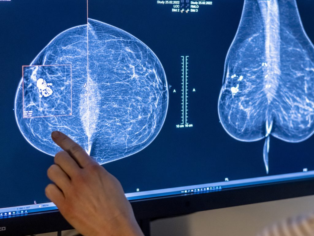 Landrat verabschiedet Krebsregister mit Opt-out